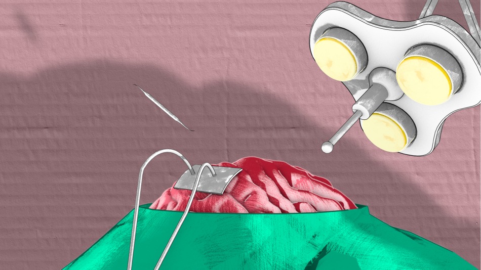 Chirurgische Szene mit offenem Gehirn unter OP-Licht. Instrumente und grüne Abdeckung sichtbar.